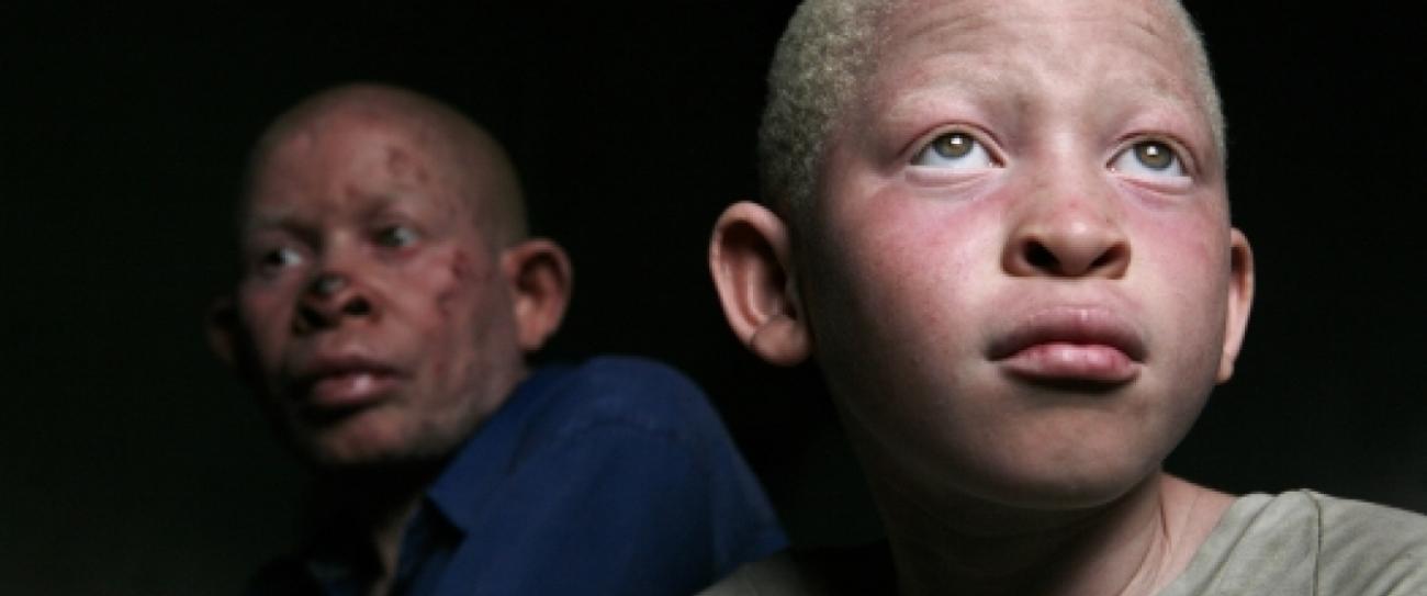 South Africa must step up action to end ‘racial discrimination” against people with albinism, says UN expert